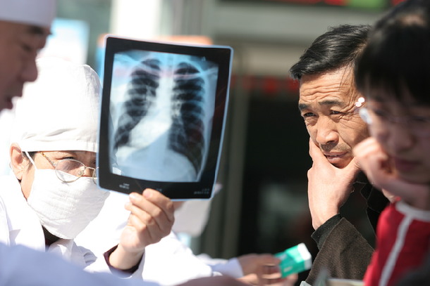 肺癌体检必知:X胸片逐渐淘汰 低剂量CT成筛查